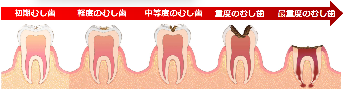 むし歯の進行図