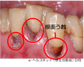 根面う蝕